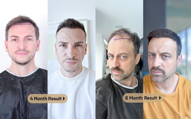 Hair Transplant in Turkey with Istanbul Vita: A Practical Overview