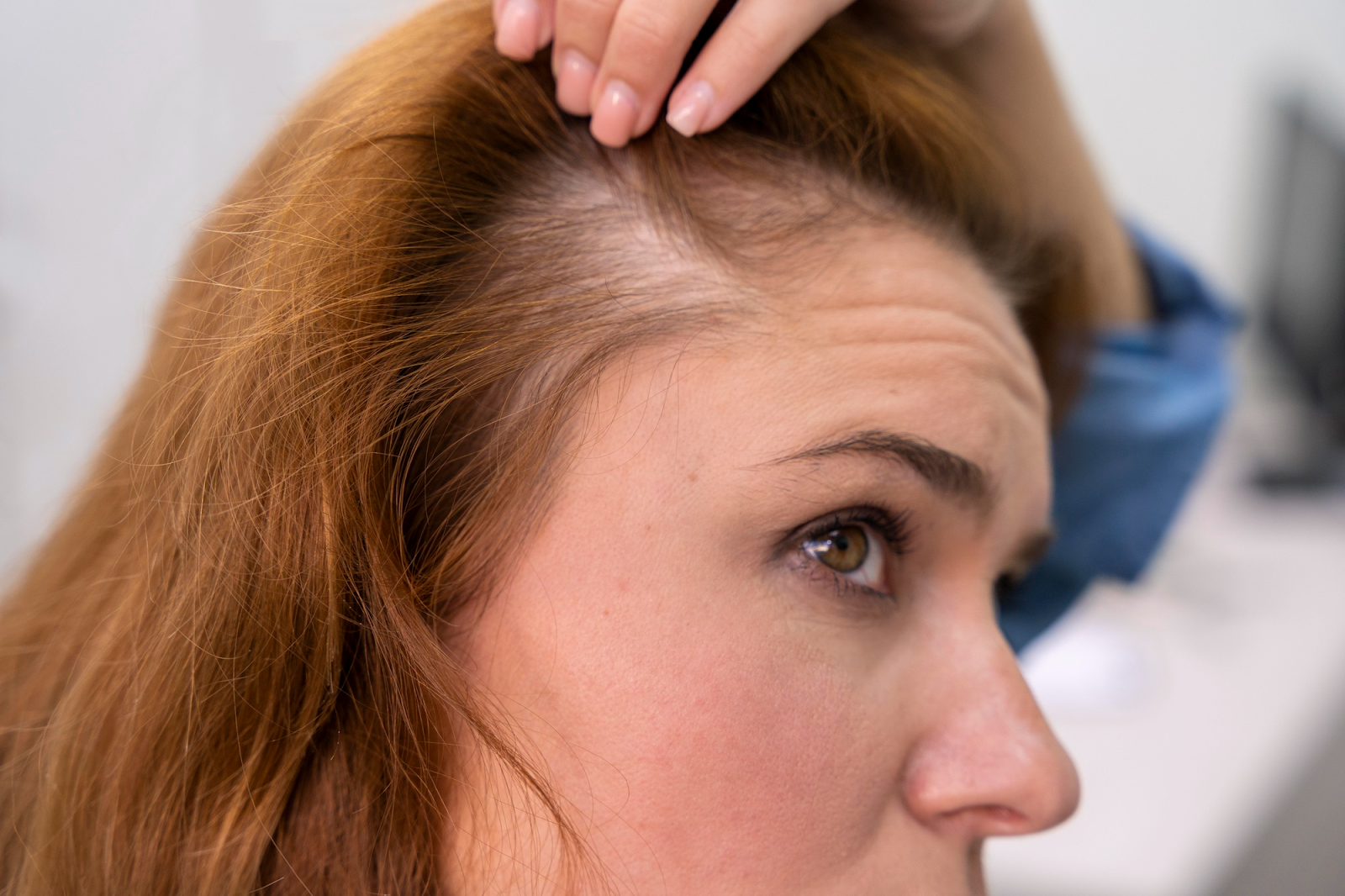 How to Choose Hair Loss Medication in Melbourne for Scarring